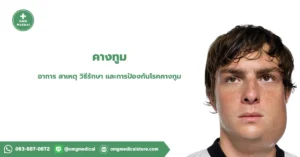 คางทูม